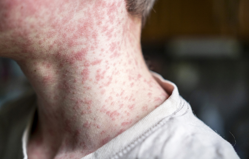 Connecticut Confirms First Measles Case of 2026